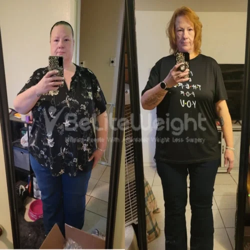 Mini Gastric Bypass before and after Patient - Hi JoAnne things have been good. I've went from 379 to 220. I kinda haven't...