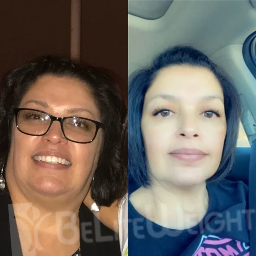 Gastric Sleeve before and after