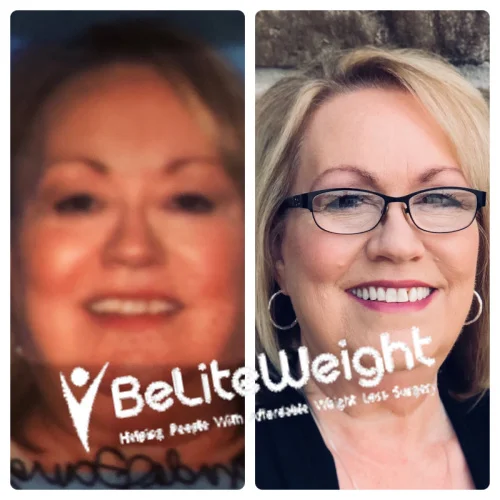 Sleeve to RNY Bypass Revision before and after Patient - I have had surgery twice with your team. The first time was for the sleeve....