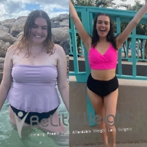 Weight Loss Surgery Gastric Sleeve before and after