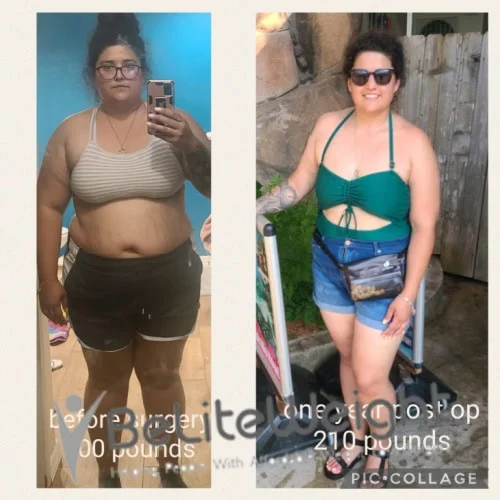 Weight Loss Surgery Gastric Sleeve before and after