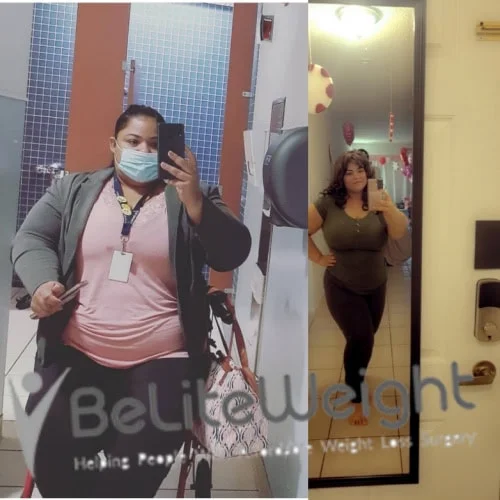 Weight Loss Surgery Before And After