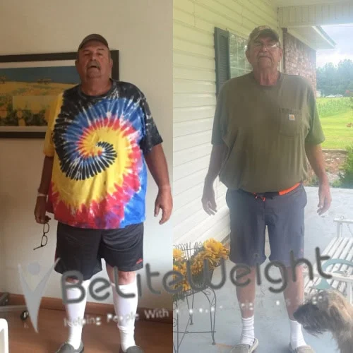 Weight Loss Surgery Before And After