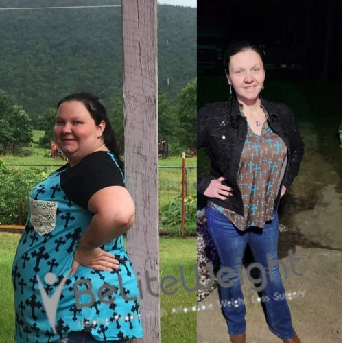 Weight Loss Surgery Gastric Sleeve before and after