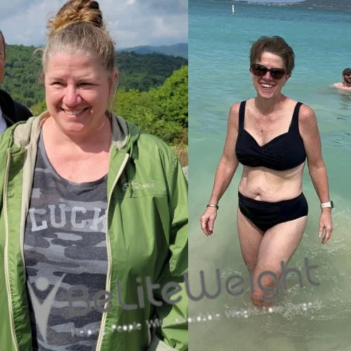 Weight Loss Surgery Gastric Sleeve before and after