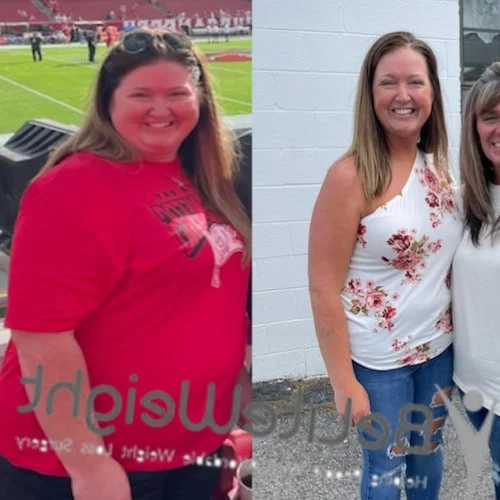 Weight Loss Surgery Before And After