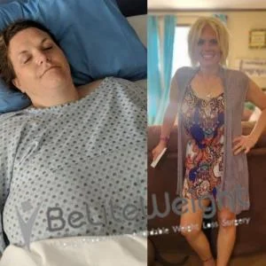 Weight Loss Surgery Before And After