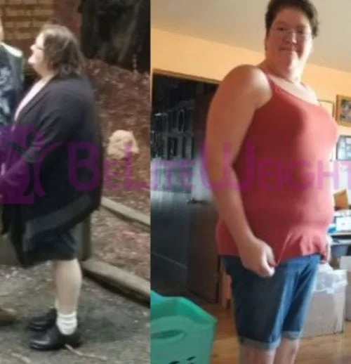 Weight Loss Surgery before and after Patient - Starting weight was 309 lb - I am at 242 now. Feeling great, off a...