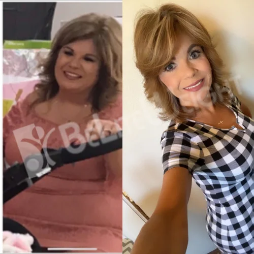 Mini Gastric Bypass before and after Woman - Maria had her mini Bypass 3 years ago.  She is now 120lbs!Mini Gastric BypassSurgeons: The...