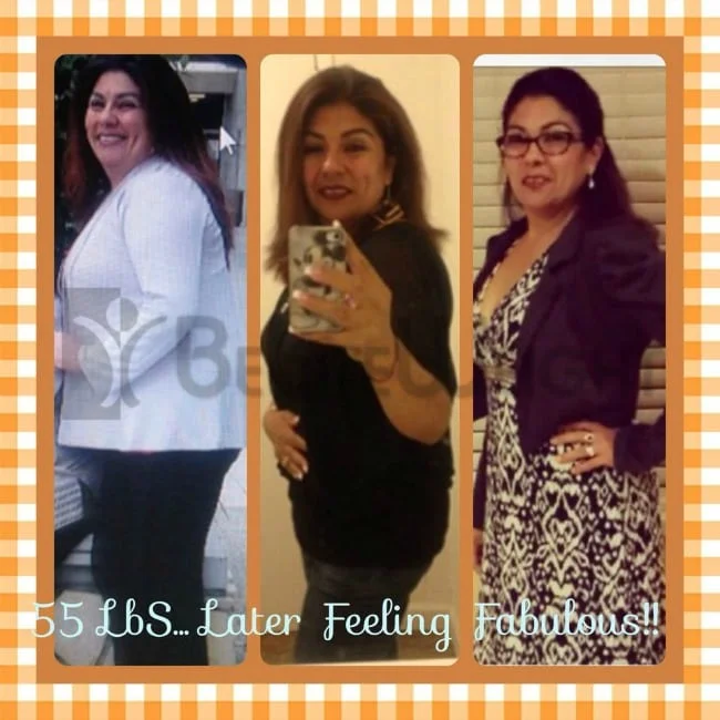 Maria Gastric Sleeve Surgery Before and After Photos