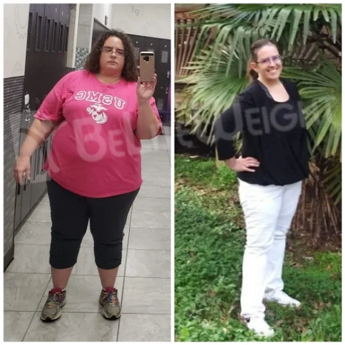 Gastric Sleeve