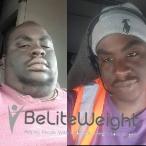 Weight Loss Surgery Before And After