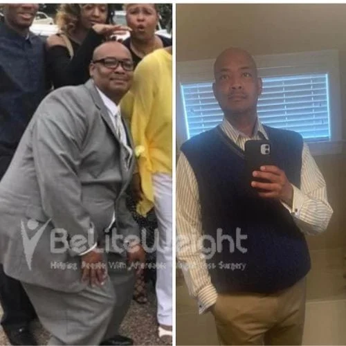 McDonald - 4 years after Gastric Sleeve Surgery