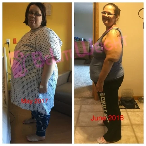 Weight Loss Surgery before and after Patient - I am currently a little over a year post op, May 11, 2017 was surgery:)...