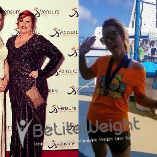 Weight Loss Surgery Before And After