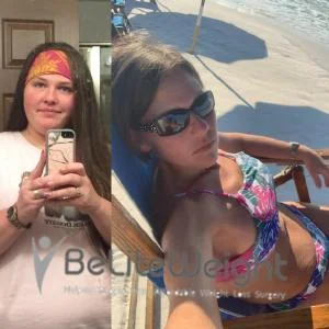 Weight Loss Surgery Before And After