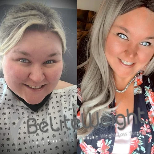 Weight Loss Surgery Before And After