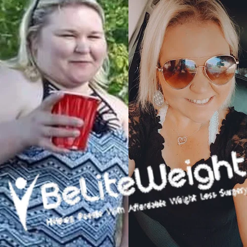 Gastric Sleeve before and after Patient - I am doing great! Highest weight was 303lbs to current 187lbsGastric SleeveSurgeons: The surgical team...