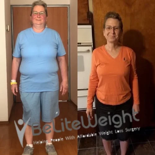 Weight Loss Surgery Gastric Sleeve before and after