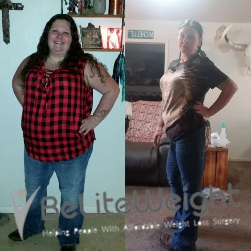 Weight Loss Surgery Gastric Sleeve before and after