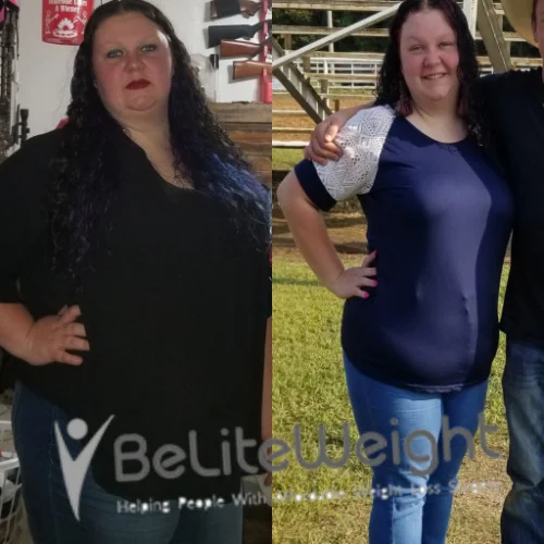 Gastric Sleeve before and after Patient - I'm doing great tho. I have slowed down on losing I'm at 200lbs. Which I'm...
