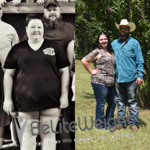 Gastric Sleeve before and after Patient - Gastric SleeveSurgeons: The surgical team of Dr. Jose Rodriguez-Villarreal, MD, FACS *See Below