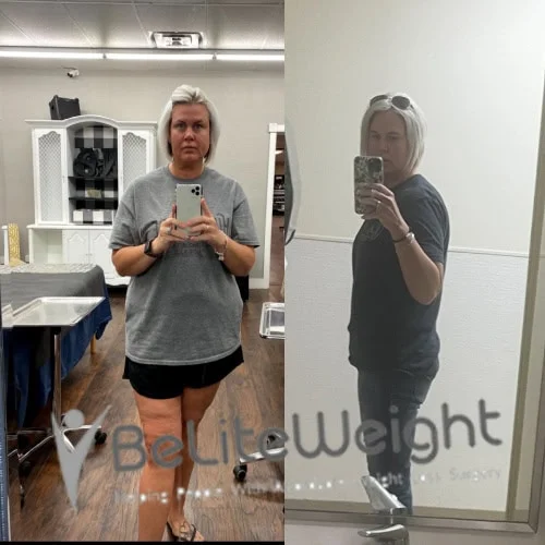 Weight Loss Surgery Gastric Sleeve before and after