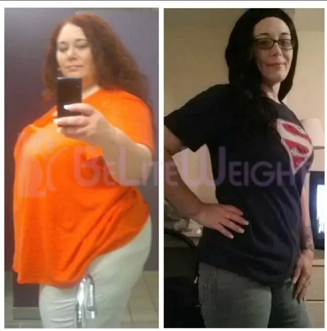 Gastric Bypass Weight Loss - 205 pounds