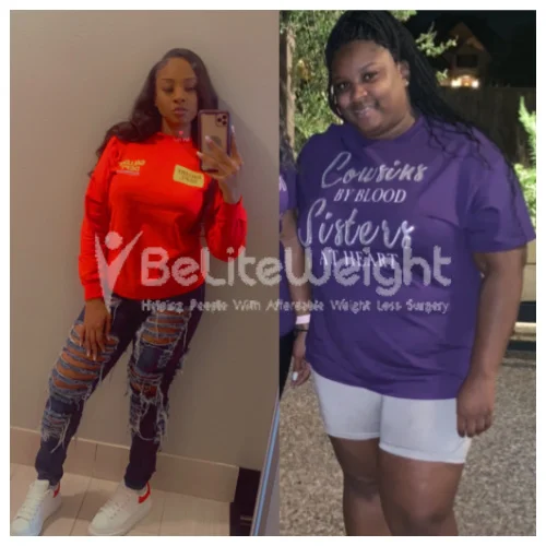 Gastric Sleeve before and after Patient - I'm doing well I've been at the same weight for over a year. Wanting to...