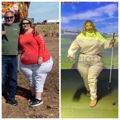 Sleeve to RNY Bypass Revision before and after Patient - I am doing good at 263 (down 100). So not where I want to be...