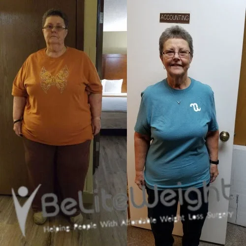 Weight Loss Surgery Before And After