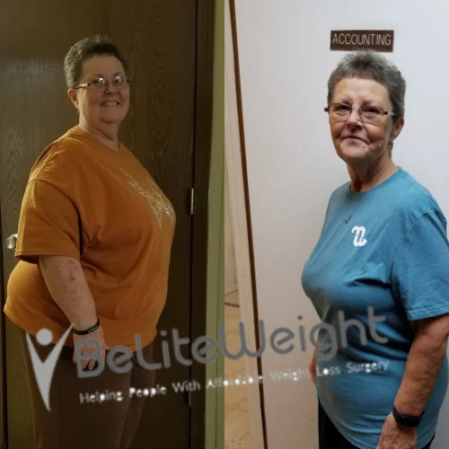 Weight Loss Surgery Gastric Sleeve before and afte