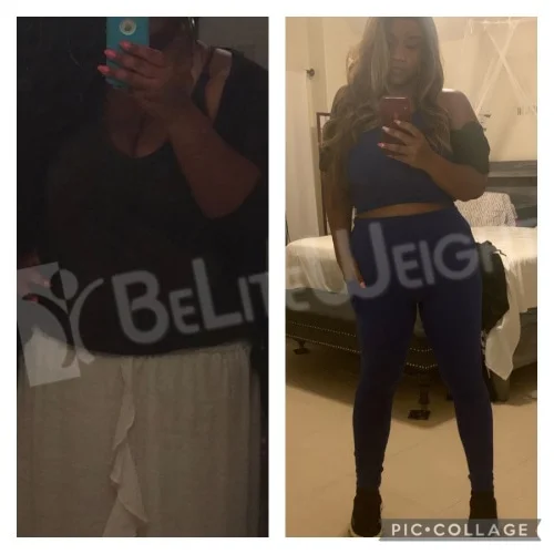 Gastric Sleeve before and after Patient - I lost 144lbs and am happy! I'm still working on losing a bit more! Gastric SleeveSurgeons:...