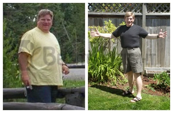 One Year After Gastric Sleeve Surgery