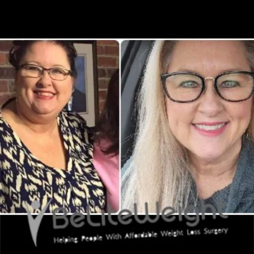 Weight Loss Surgery Gastric Sleeve before and after