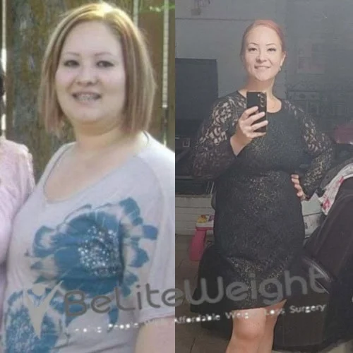 Weight Loss Surgery Gastric Sleeve before and after