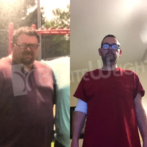 RNY Gastric Bypass before and after Patient - My Gastric Bypass surgery was July 26, 2019. Before surgery I was 365 and now...