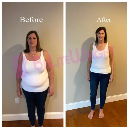 Gastric Sleeve before and after