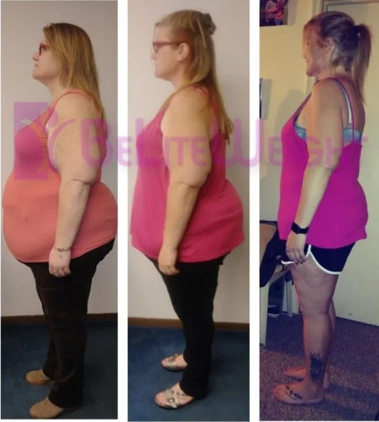 Weight Loss Surgery before and after Patient - Just wanted to share my progress pictures to the ones who gave me an open...