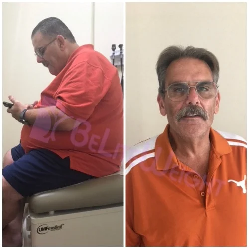 Weight Loss Surgery before and after Patient - Surgeon Dr. Jose RodriguezProcedure Gastric Sleeve *See Below