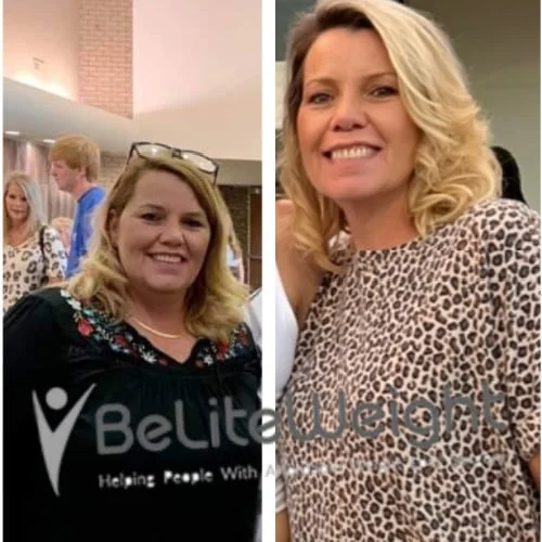 Weight Loss Surgery Gastric Sleeve before and after