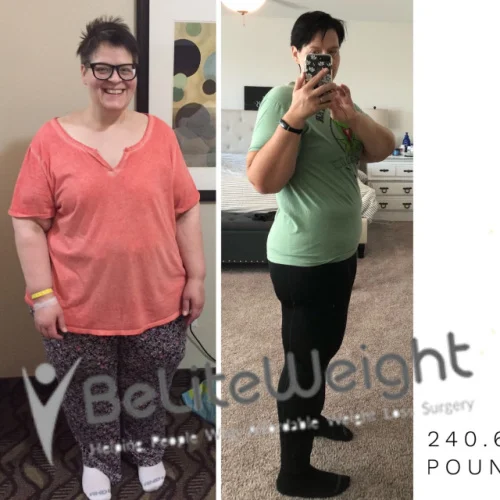 Weight Loss Surgery Gastric Sleeve before and after