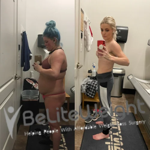 Weight Loss Surgery Gastric Sleeve before and after