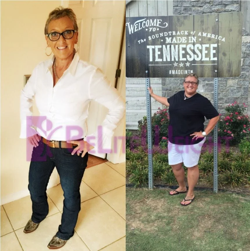 Weight Loss Surgery before and after Patient - Surgeon Dr. Wayne WestmorelandProcedure Gastric Sleeve *See Below