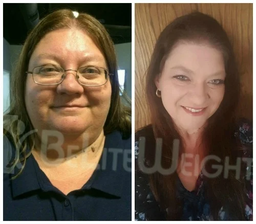 weight loss surgery vsg gastric sleeve bypass band before and after