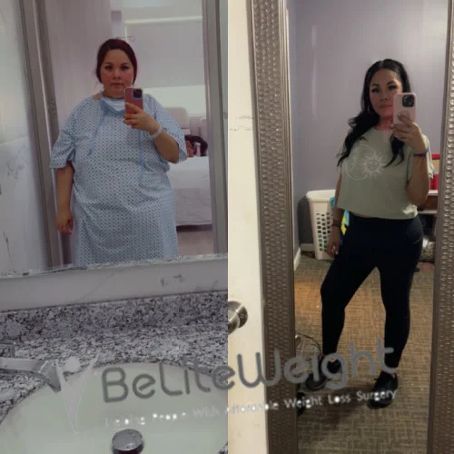 Metabolic RNY Bypass for Diabetes before and after Patient -  I started at 280 a year ago and now I'm at 149 and I feel...