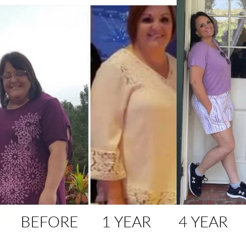 Weight Loss Surgery Before And After