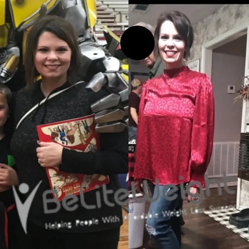 Weight Loss Surgery Before And After