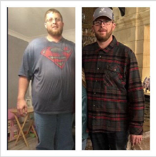 Metabolic RNY Bypass for Diabetes before and after Patient - Everything with the program in its entirety was smooth and very straight forward even with...