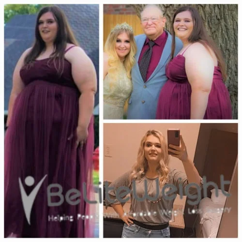 Weight Loss Surgery Gastric Sleeve before and after